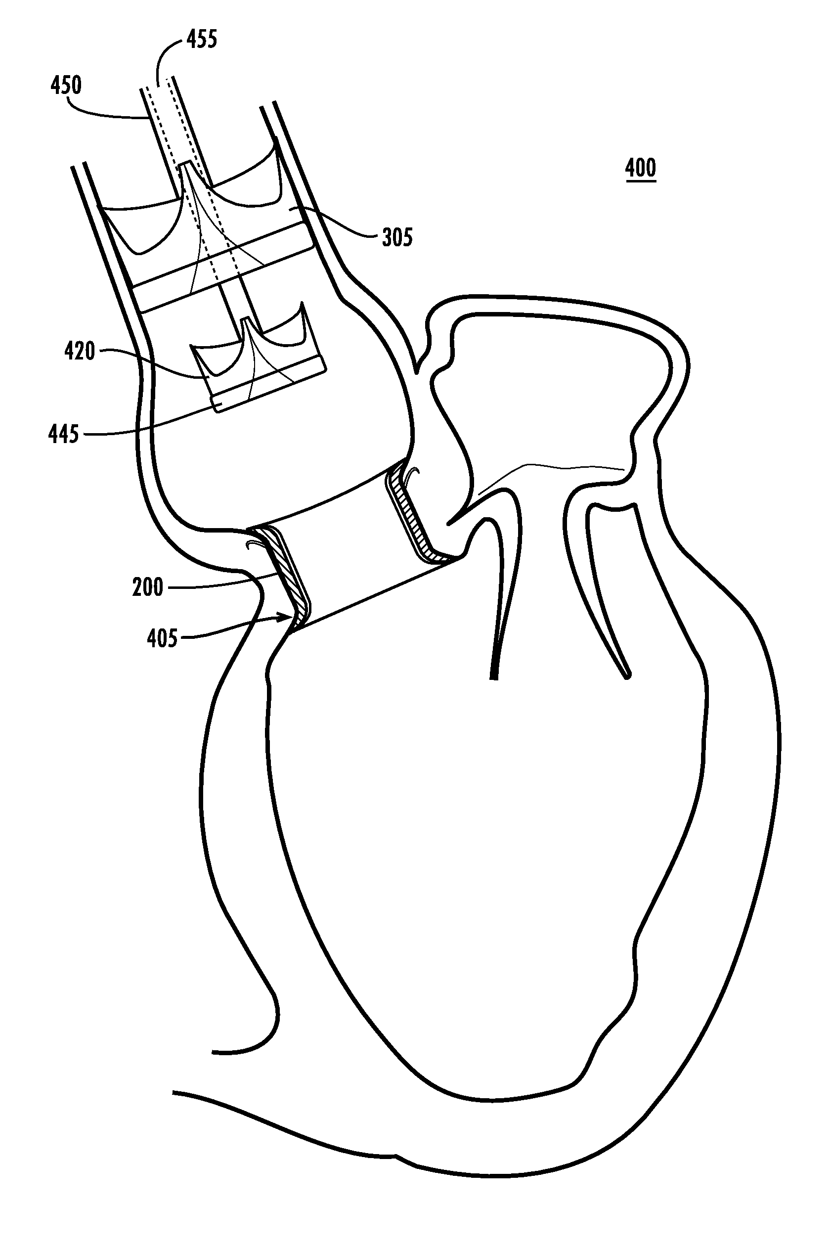 Replaceable Heart Valve Prosthesis