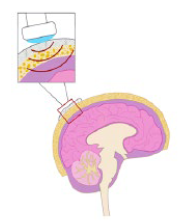 Allowing Ultrasound to Penetrate the Skull for Diagnosis and Treatment