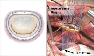 Annuloplasty Ring & Methods for Tricuspid Valve Repair
