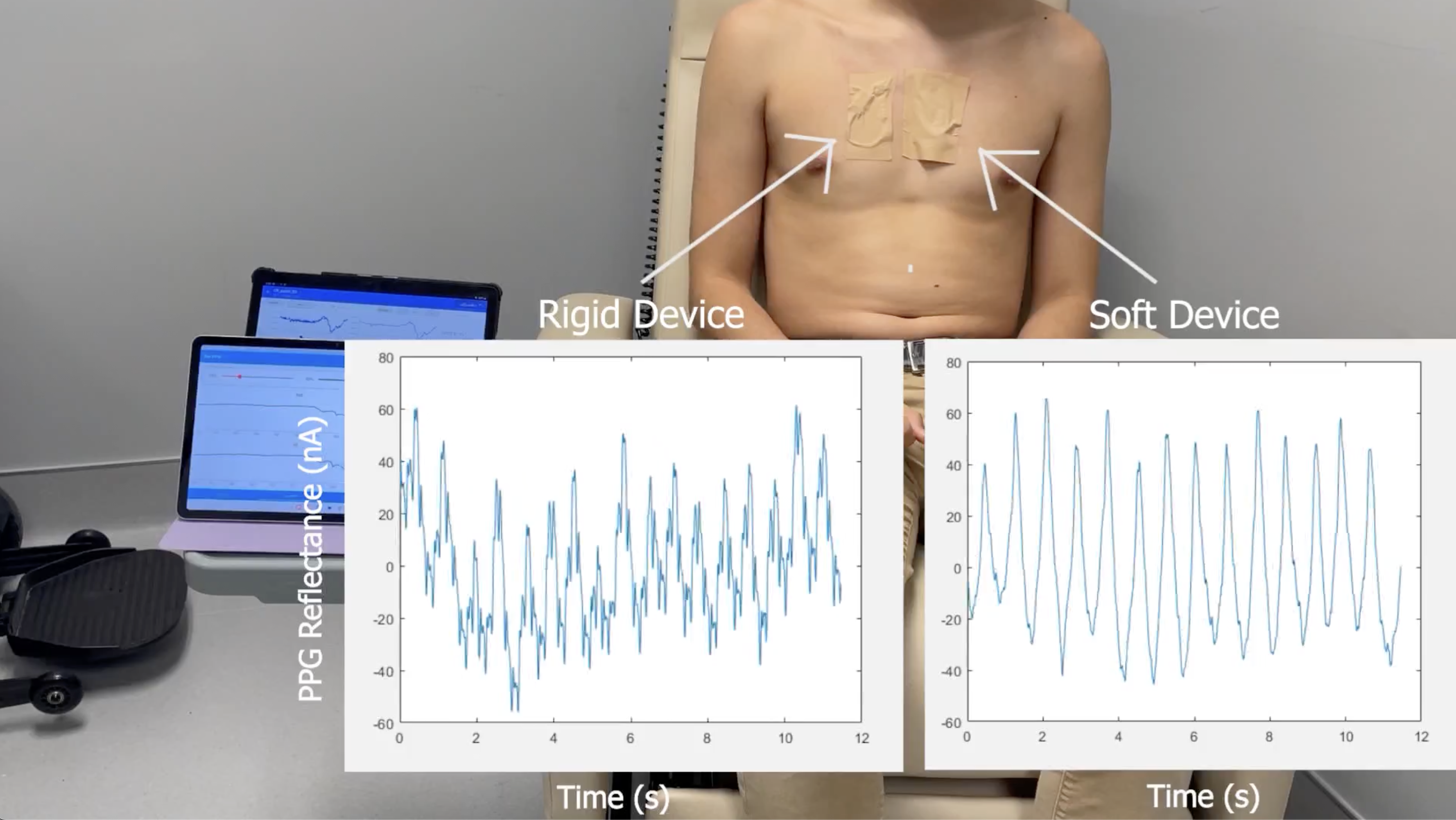 Young man wearing two sensors—one rigid and this soft patch. Vasoconstriction is monitored. 