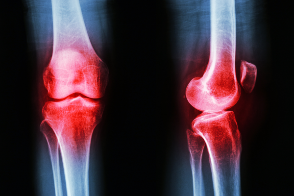 X-ray of knees against a black background. Knees are colored red.